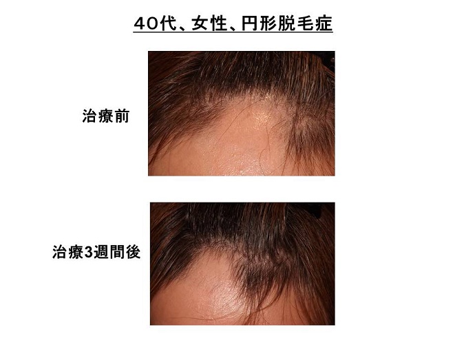 円形脱毛症　病院""
